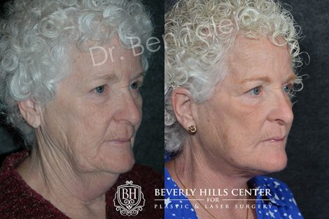 Neck and Face Lift - Right Side