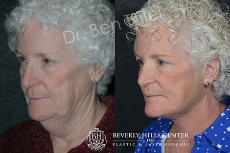 Neck and Face Lift - Left Side
