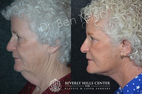Neck and Face Lift - Left Side