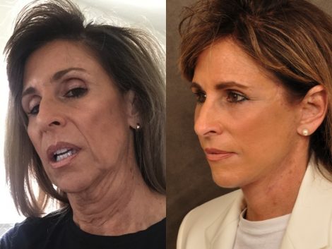 Beverly Hills Center Female Patient Before and After Face and Neck Rejuvenation Procedures