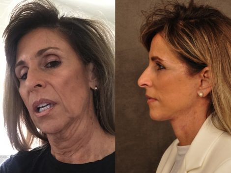 Beverly Hills Center Female Patient Before and After Face and Neck Rejuvenation Procedures