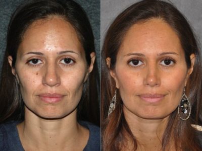 Closed, Minimal Access 3-D Telescopic Rhinoplasty / Nosejob