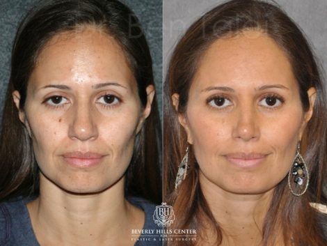 Closed, Minimal Access 3-D Telescopic Rhinoplasty / Nosejob