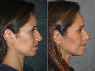 Closed, Minimal Access 3-D Telescopic Rhinoplasty / Nosejob