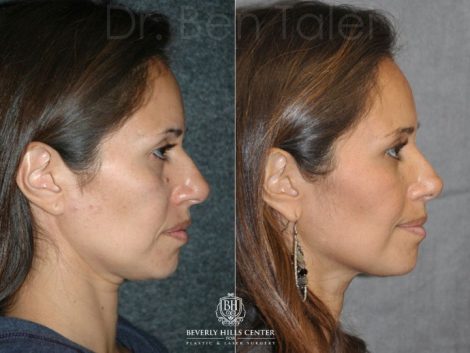 Closed, Minimal Access 3-D Telescopic Rhinoplasty / Nosejob