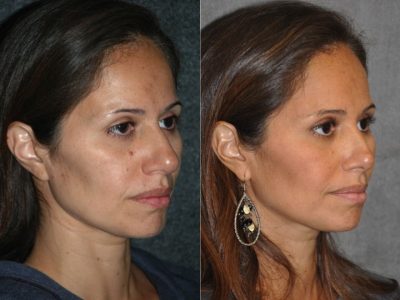 Closed, Minimal Access 3-D Telescopic Rhinoplasty / Nosejob