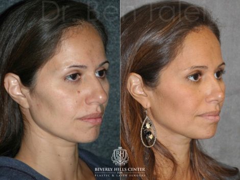 Closed, Minimal Access 3-D Telescopic Rhinoplasty / Nosejob