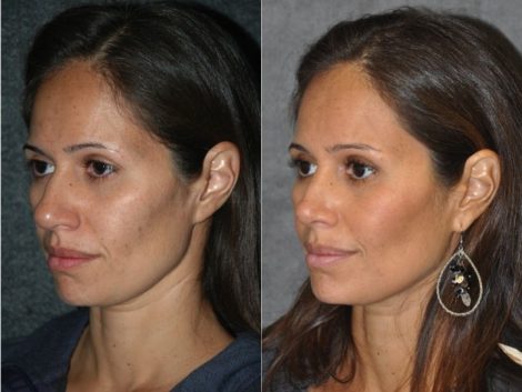 Closed, Minimal Access 3-D Telescopic Rhinoplasty / Nosejob