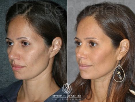 Closed, Minimal Access 3-D Telescopic Rhinoplasty / Nosejob
