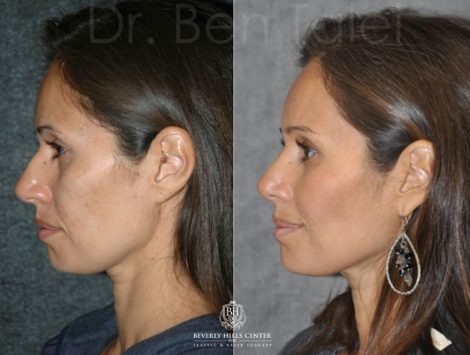 Closed, Minimal Access 3-D Telescopic Rhinoplasty / Nosejob