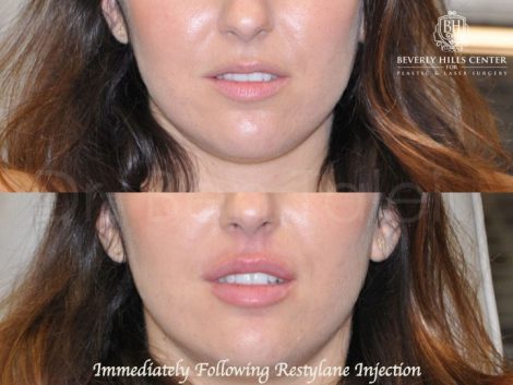Beverly Hills Center Female Patient Before and After Lip Filler Procedure