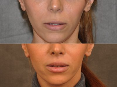 Modified Upper Lip Lift - Front