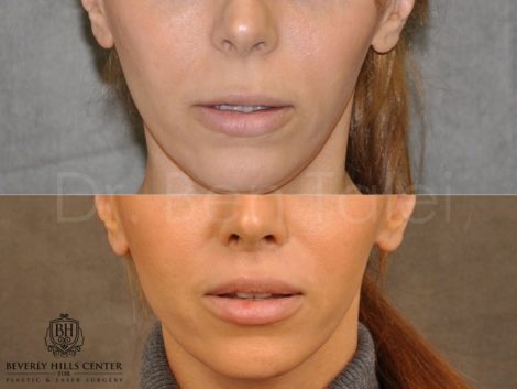 Modified Upper Lip Lift - Front
