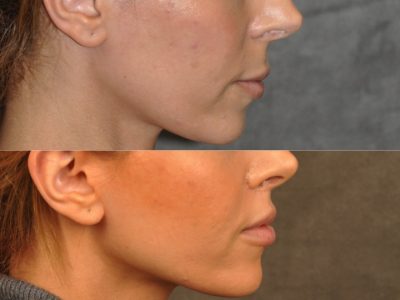 Modified Upper Lip Lift - Right Side