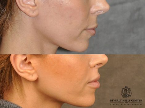 Modified Upper Lip Lift - Right Side