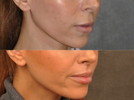 Modified Upper Lip Lift - Right Side
