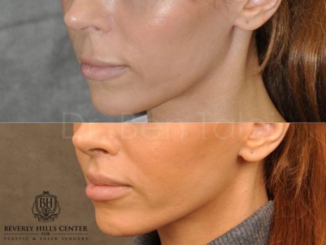 Modified Upper Lip Lift - Left Side