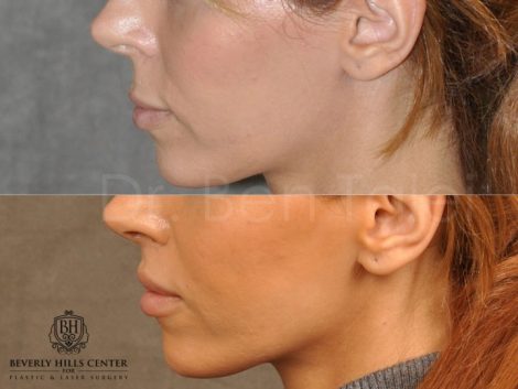 Modified Upper Lip Lift - Left Side