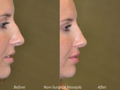 Non Surgical Rhinoplasty / Liquid NoseJob