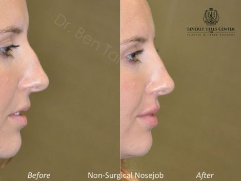 Non Surgical Rhinoplasty / Liquid NoseJob