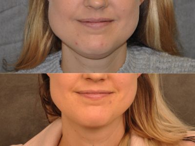 Microliposuction of Neck & Chin with Chin tuck and masseter botox/dysport – Front