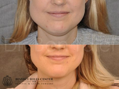 Microliposuction of Neck & Chin with Chin tuck and masseter botox/dysport – Front