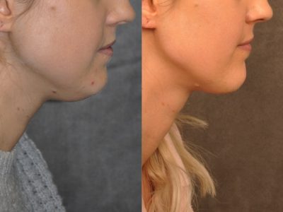 Microliposuction of Neck & Chin with Chin tuck and masseter botox/dysport – Right Side