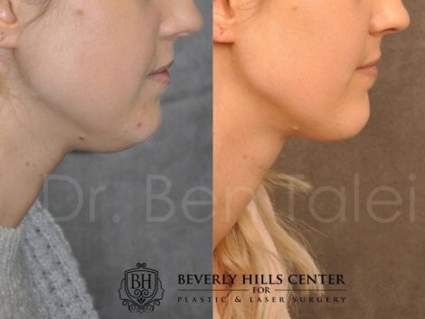 Microliposuction of Neck & Chin with Chin tuck and masseter botox/dysport – Right Side