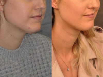 Microliposuction of Neck & Chin with Chin tuck and masseter botox/dysport – Right Side