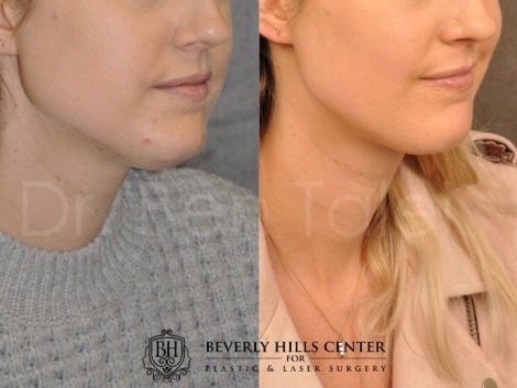 Microliposuction of Neck & Chin with Chin tuck and masseter botox/dysport – Right Side