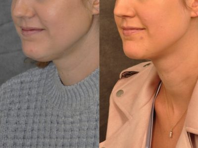 Microliposuction of Neck & Chin with Chin tuck and masseter botox/dysport – Left Side