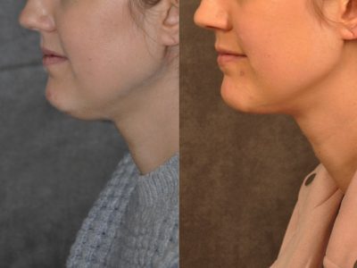 Microliposuction of Neck & Chin with Chin tuck and masseter botox/dysport – Left Side