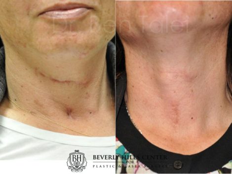 Beverly Hills Center Female Patient Before and After Neck Scar Removal