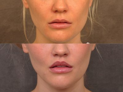 Modified Upper Lip Lift - Front