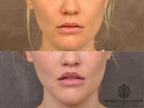 Modified Upper Lip Lift - Front