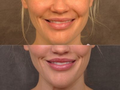 Modified Upper Lip Lift - Front