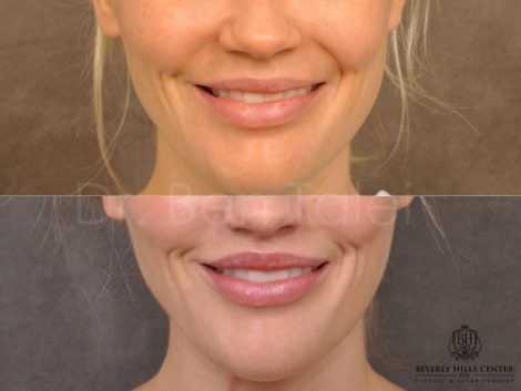 Modified Upper Lip Lift - Front