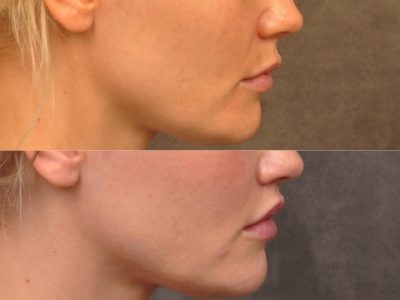Modified Upper Lip Lift - Right Side