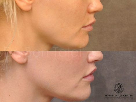 Modified Upper Lip Lift - Right Side
