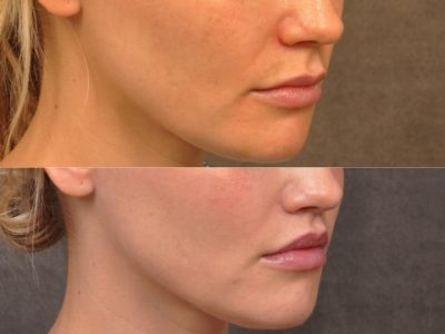 Modified Upper Lip Lift - Right Side