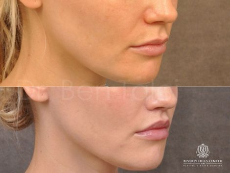 Modified Upper Lip Lift - Right Side