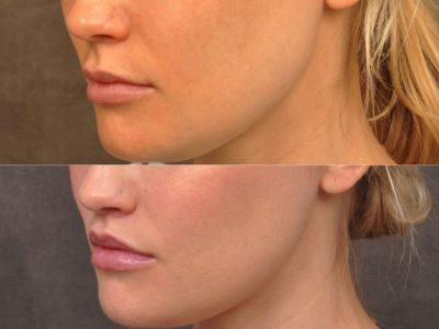 Modified Upper Lip Lift - Left Side