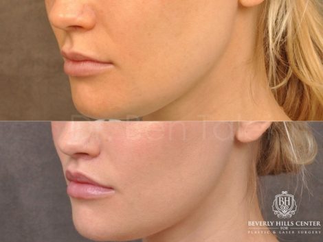 Modified Upper Lip Lift - Left Side