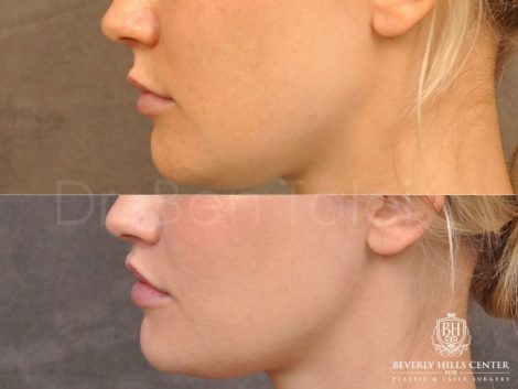 Modified Upper Lip Lift - Left Side