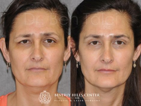 Beverly Hills Center Female Patient Before and After Eyebrow Lift Procedure