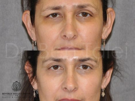 Beverly Hills Center Female Patient Before and After Eyebrow Lift Procedure