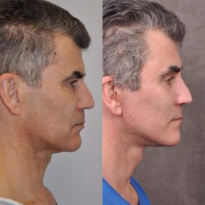 AuraLyft for Men with rejunenation around the eyes - Right Side