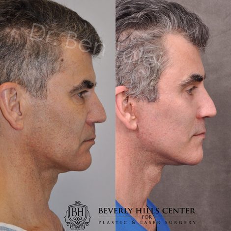 AuraLyft for Men with rejunenation around the eyes - Right Side