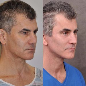 AuraLyft for Men with rejunenation around the eyes - Right Side
