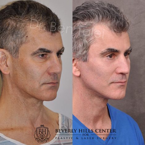 AuraLyft for Men with rejunenation around the eyes - Right Side